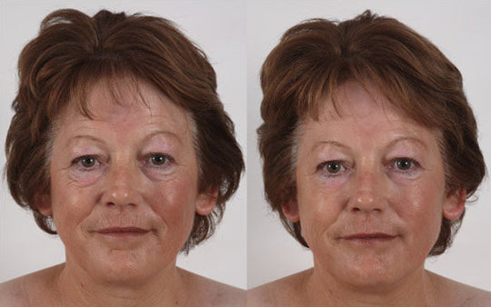before and after images of a woman with short brown hair after microcurrent facial