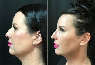 before and after picture of woman with loose and tight neck skin