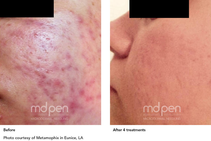 before and after of a woman's cheek before and after microneedle facials